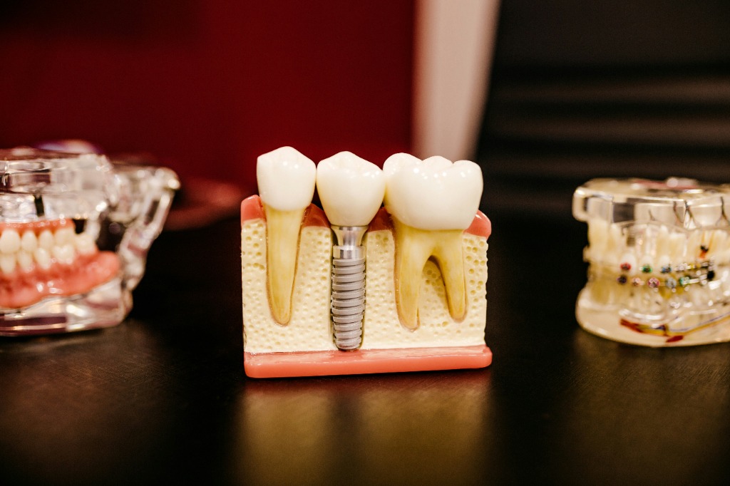 Dental Implant – before